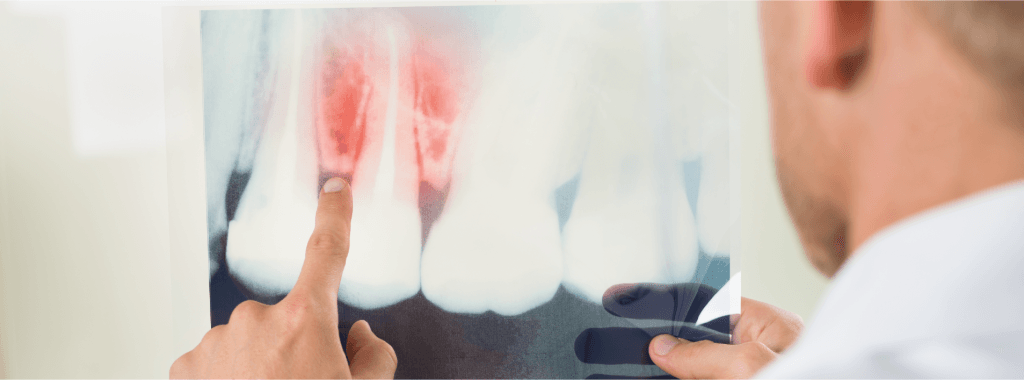 Cura parodontite a Rubiera 2