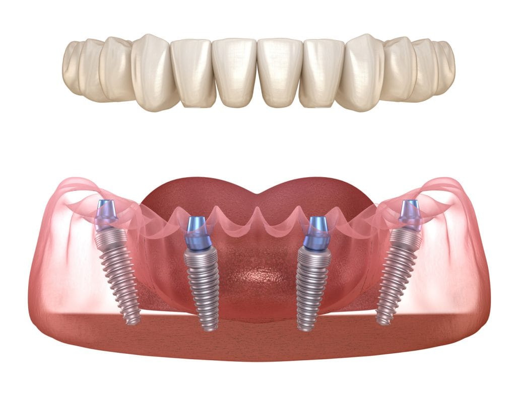 Impianti dentali