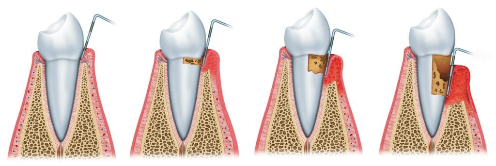 Curare parodontite con laser - parodontologia