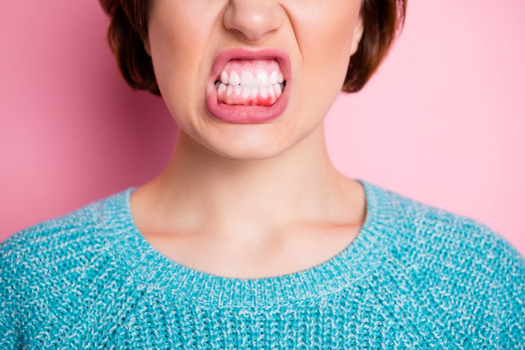 Come riconoscere la parodontite - salute dei denti