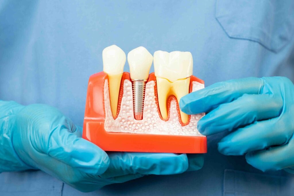 Differenza tra denti naturali e impianti dentali