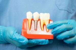 Differenza tra denti naturali e impianti dentali